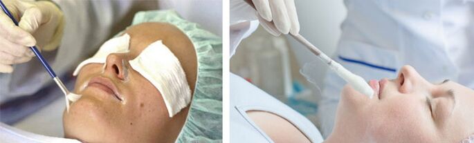 peeling e crioterapia para o rexuvenecemento da pel
