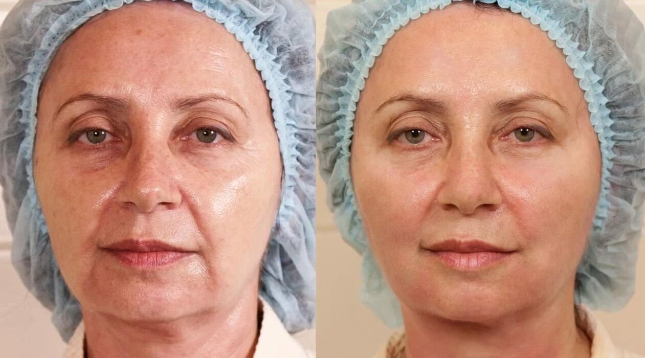 Fotos de antes e despois de lavado de cara