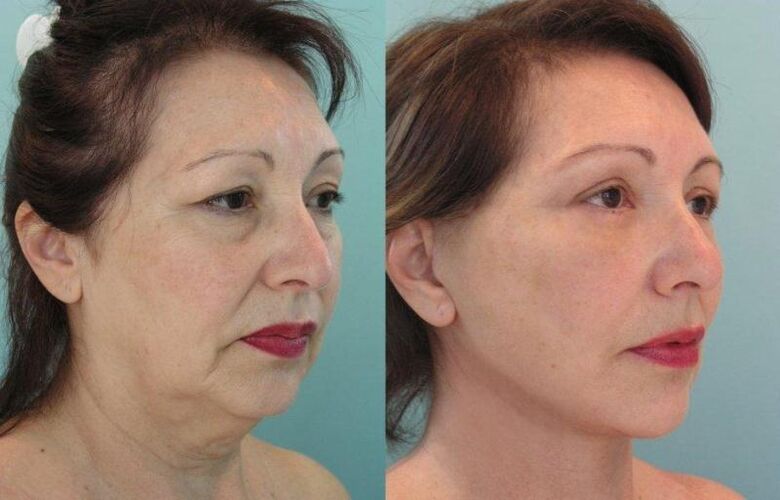 O resultado do rexuvenecemento da pel facial con fíos