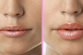 antes e despois do procedemento de restauración dos beizos